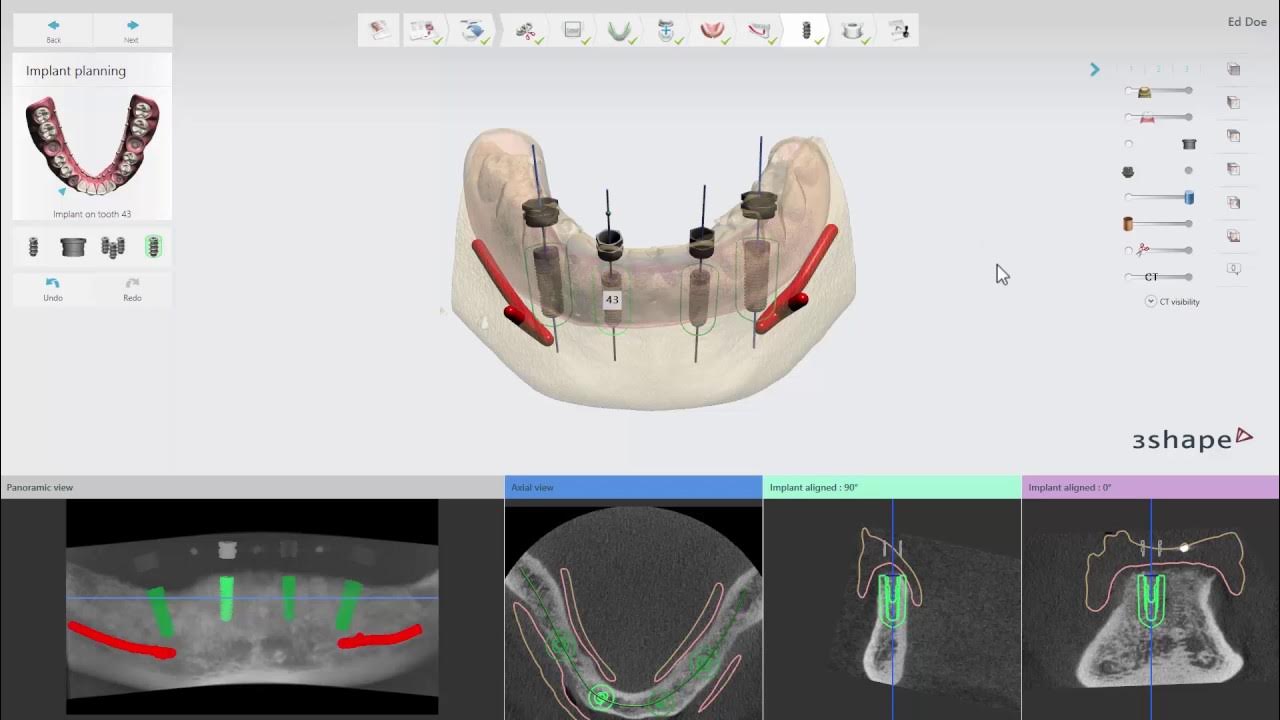 3Shape Implant Studio photo by dental-soft.com